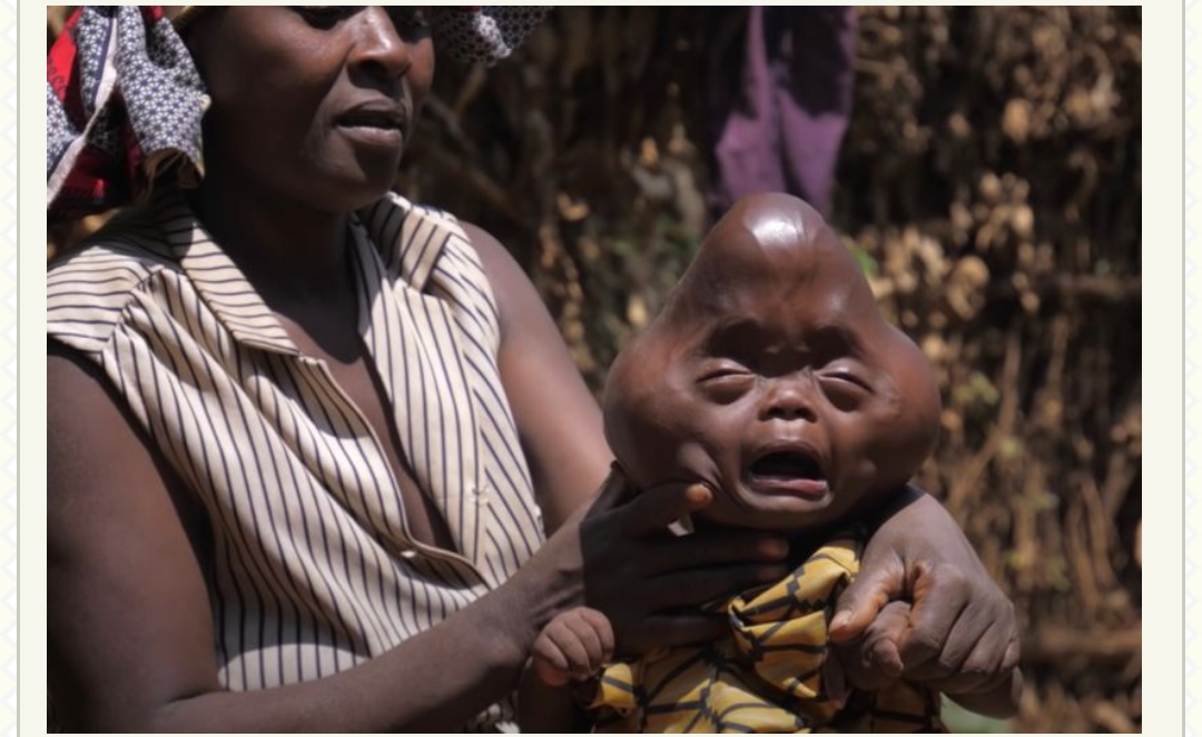 N32m Raised To Treat Deformed Baby Rejected By His Father (Pictures)